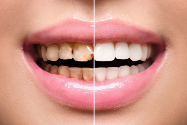 BleachingTeeth-Whitening-768x545
