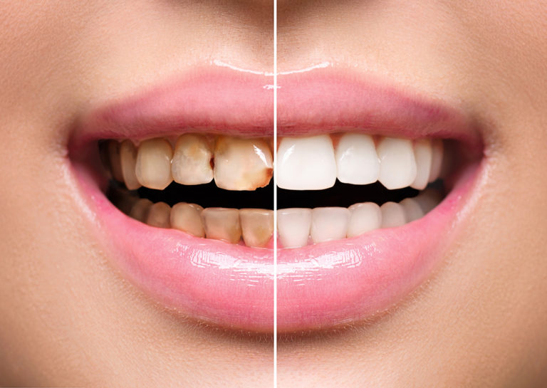 BleachingTeeth-Whitening-768x545